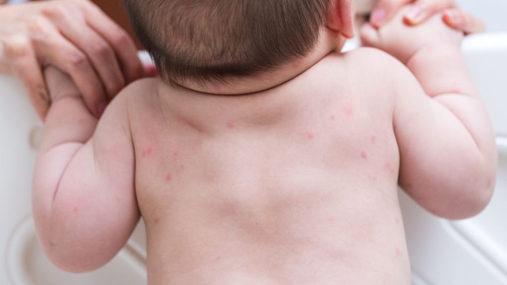 Bintik Merah DBD pada Bayi