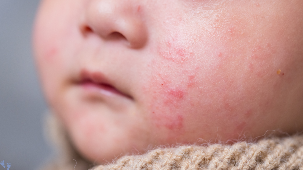 cara mengatasi keringat buntet pada bayi