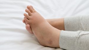 Cara Mengobati Kaki Bengkak Karena Keseleo