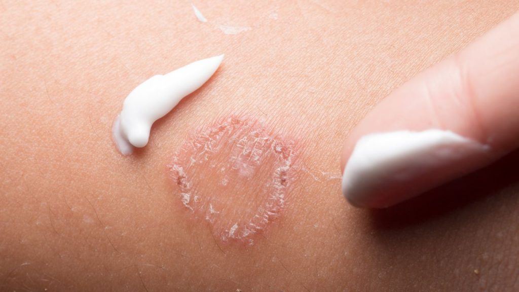 Apakah Kurap Bisa Menyebar Ini