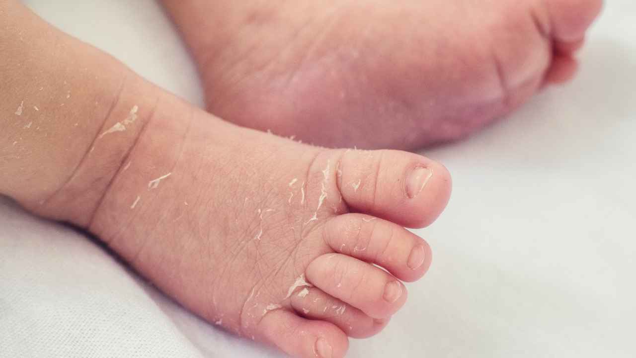 kulit kering dan mengelupas