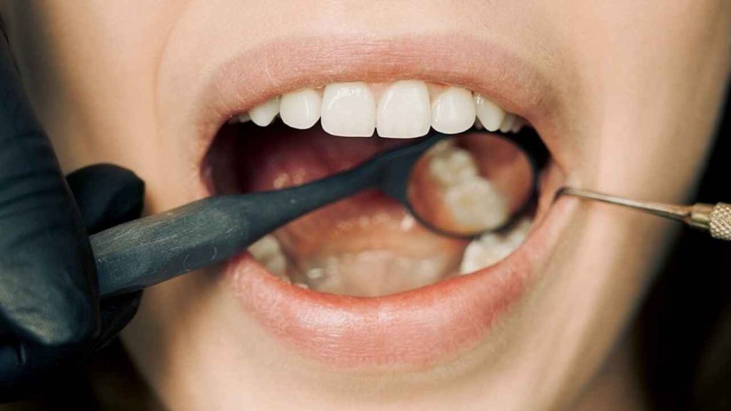 penyebab gigi keropos di usia muda