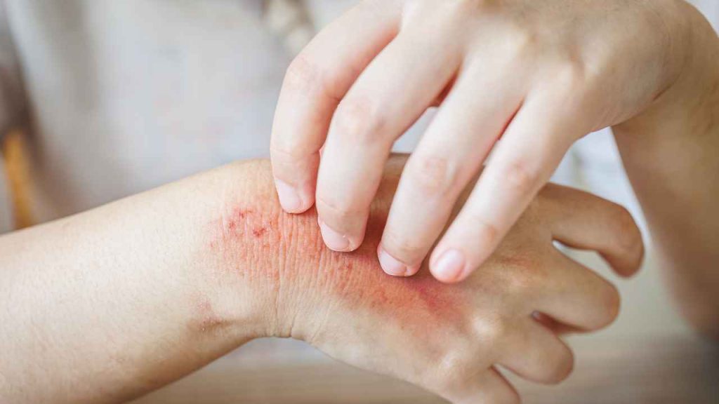 bekas gigitan kamitetep