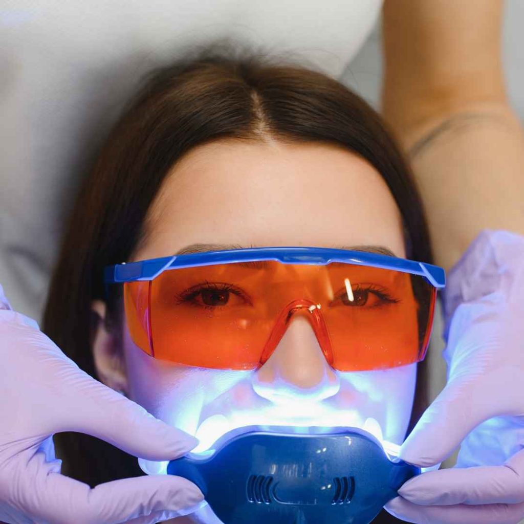 Apa itu Bleaching Gigi