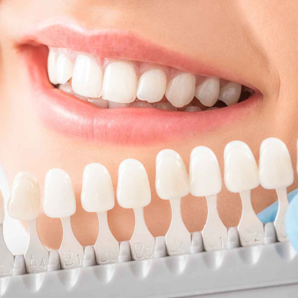 Berapa Lama Bertahan Bleaching Gigi