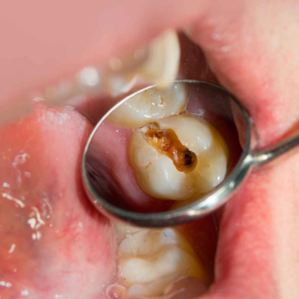 Penyebab Saraf Gigi Sakit