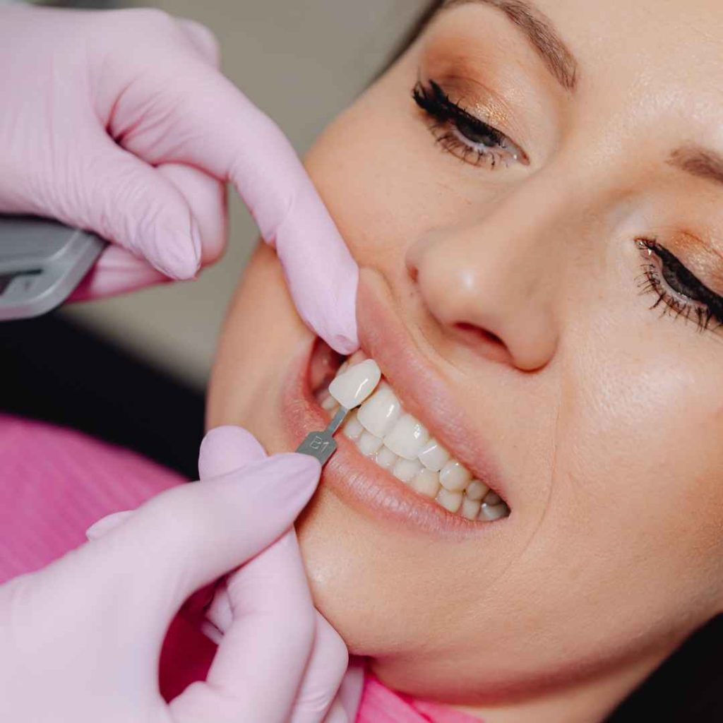 perbedaan veneer dan bleaching gigi