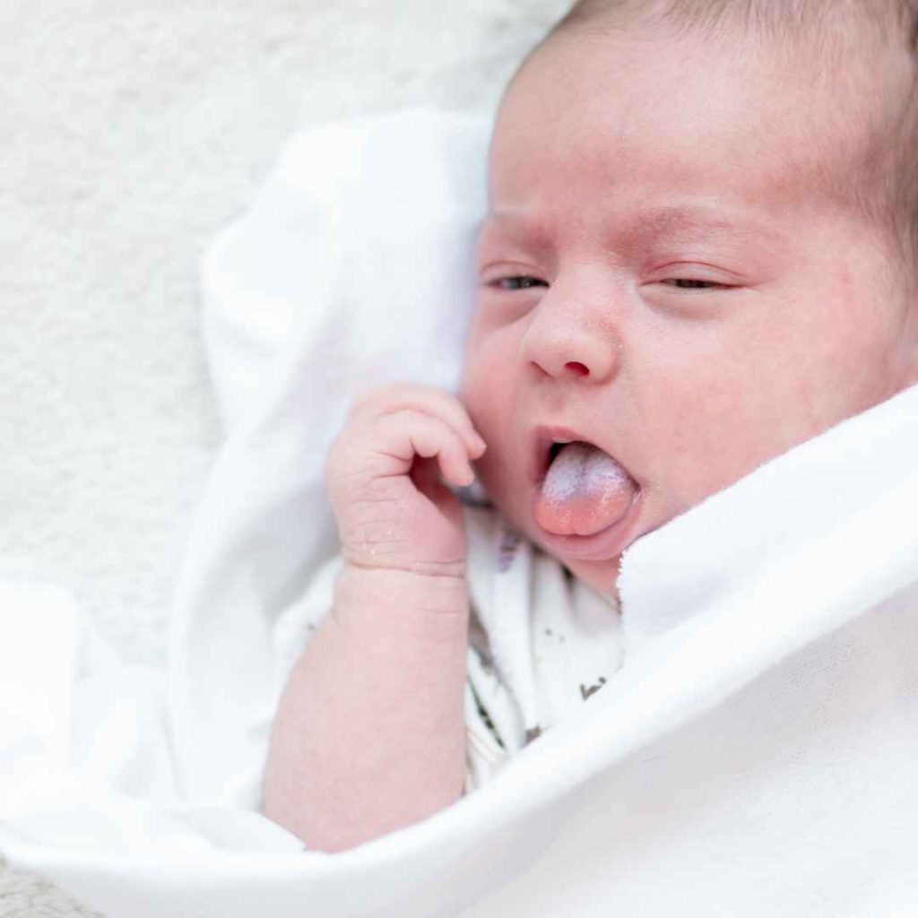 bercak putih pada mulut bayi