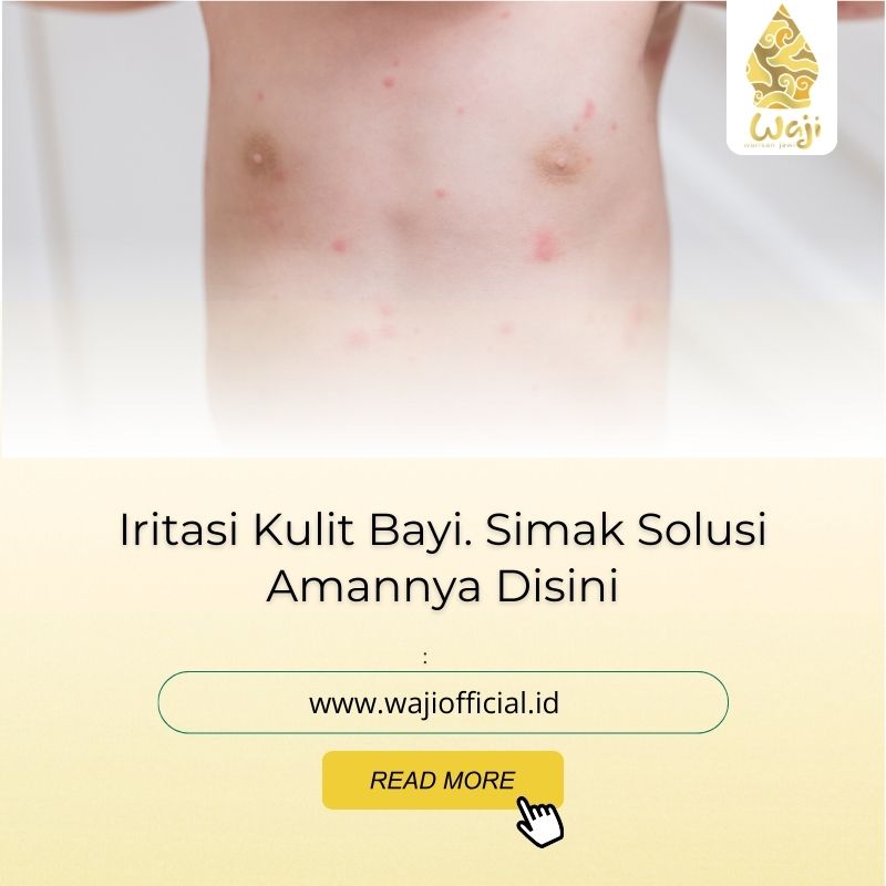 Mengenal Iritasi Kulit Bayi dan Cara Aman Mengatasinya