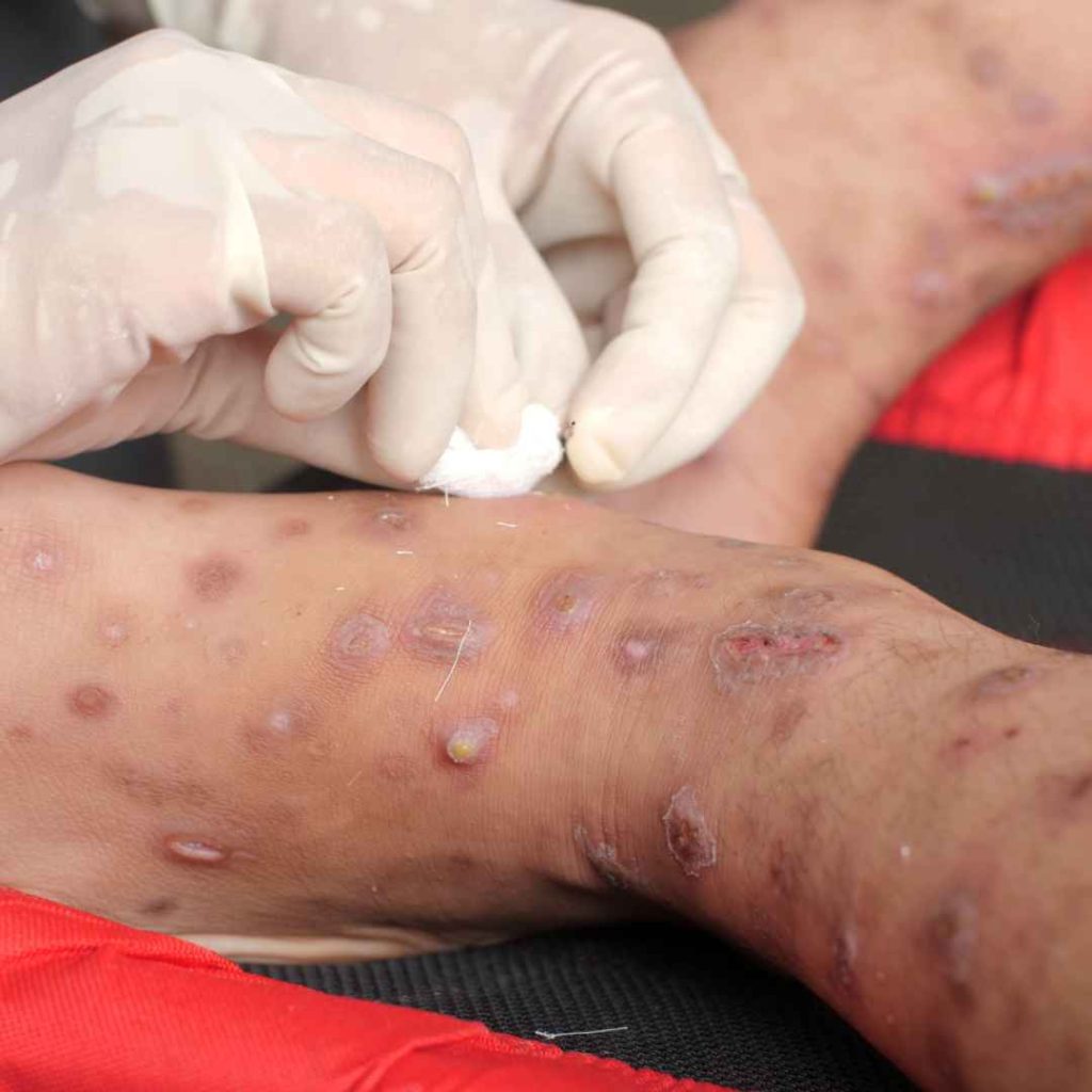 penyebab scabies pada manusia