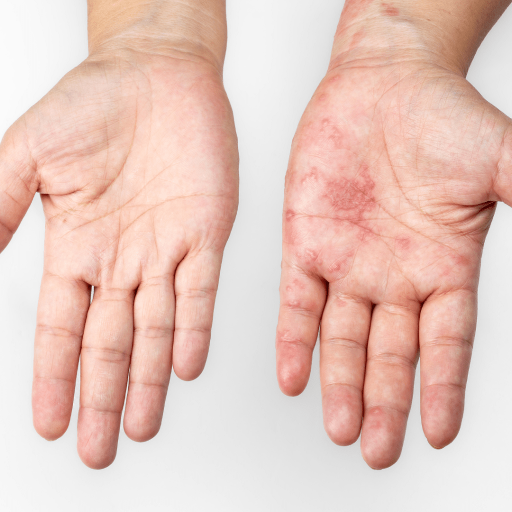 penyebab scabies pada manusia