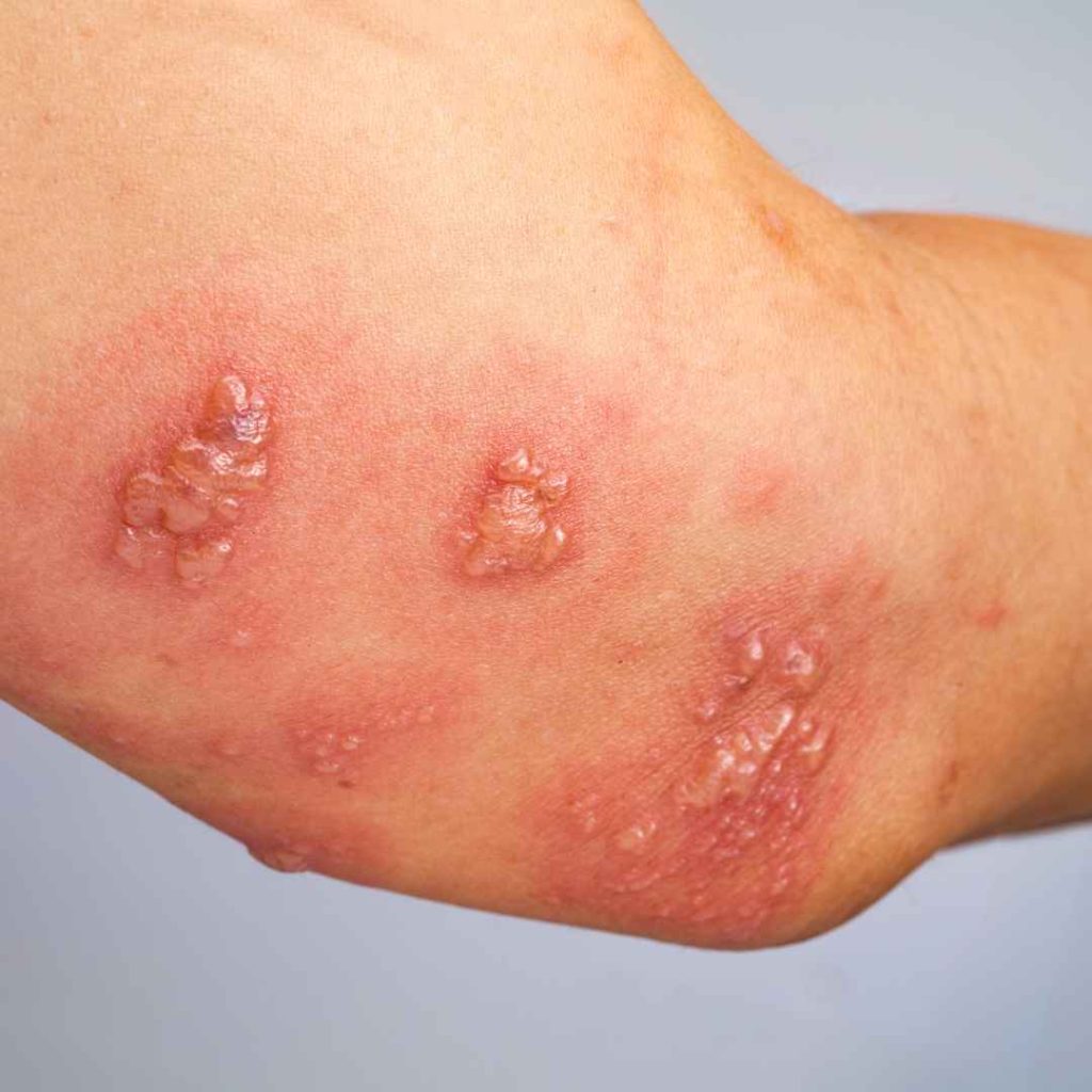 penyebab scabies pada manusia