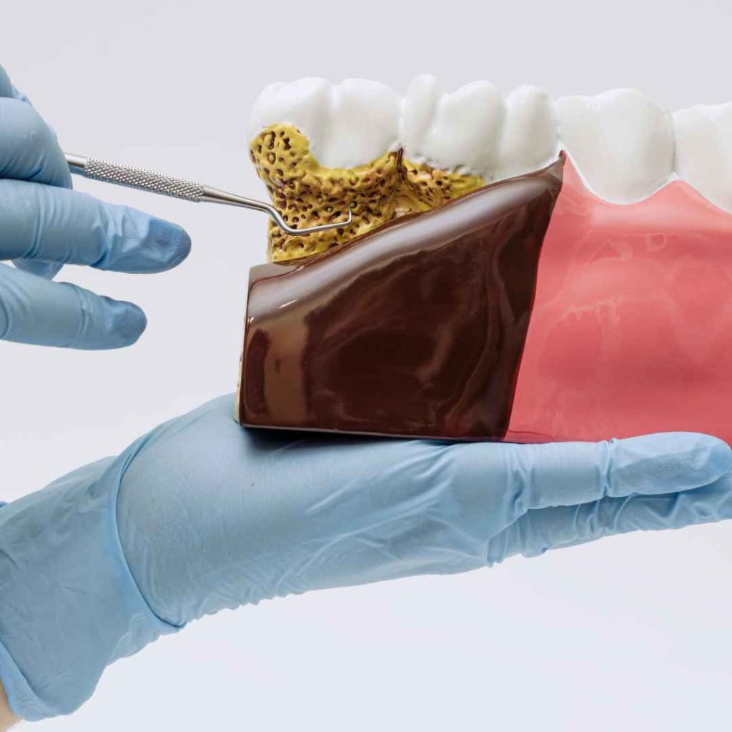 perbedaan plak dan karang gigi