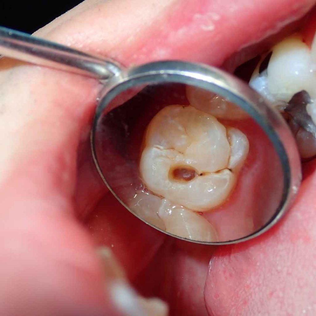 bakteri pada gigi berlubang