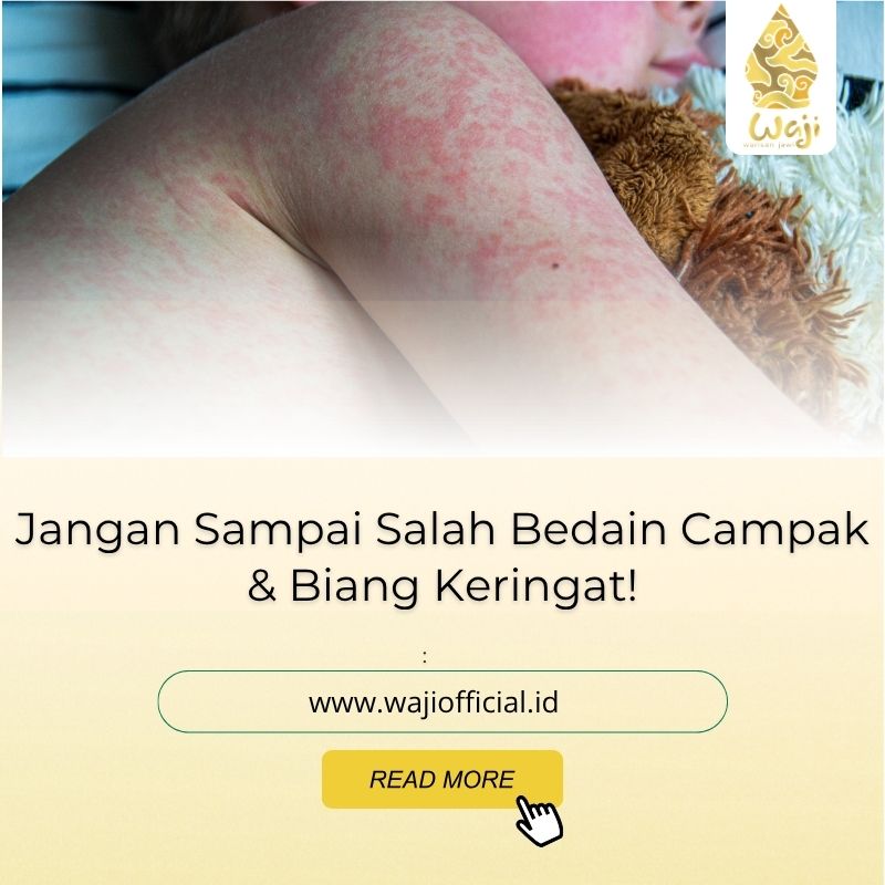 Perbedaan Campak dan Biang Keringat, Bisa Dilihat Sendiri Langsung