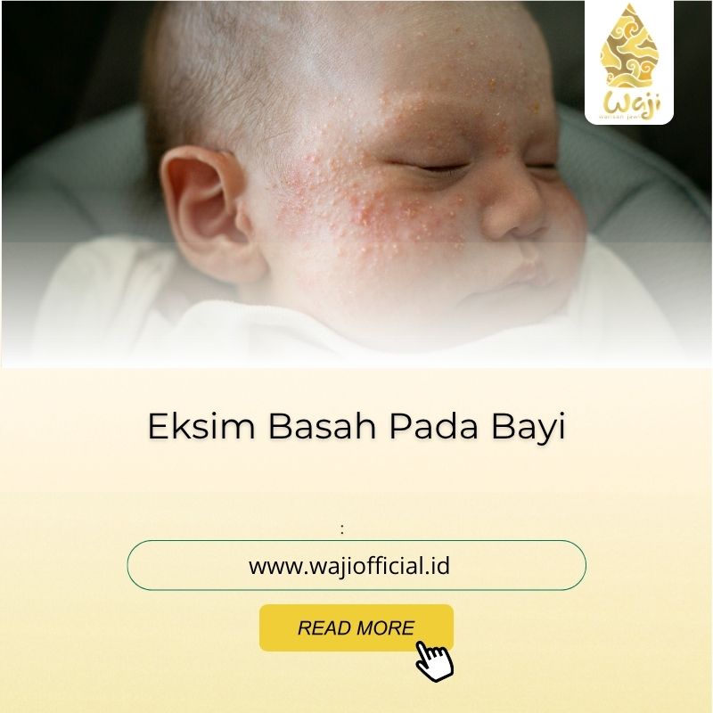 eksim basah pada bayi