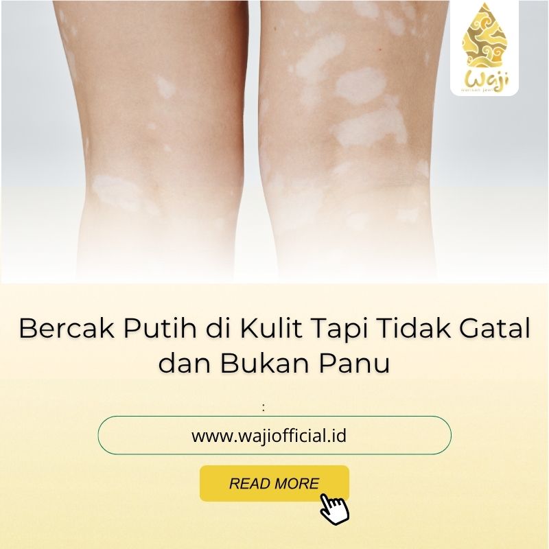 bintik putih pada kulit tapi tidak gatal